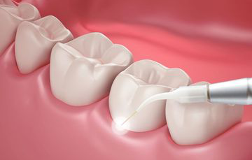 Dental jewellery